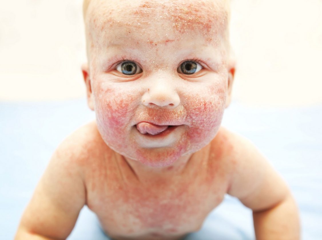 Аллергия на еду у детей фото